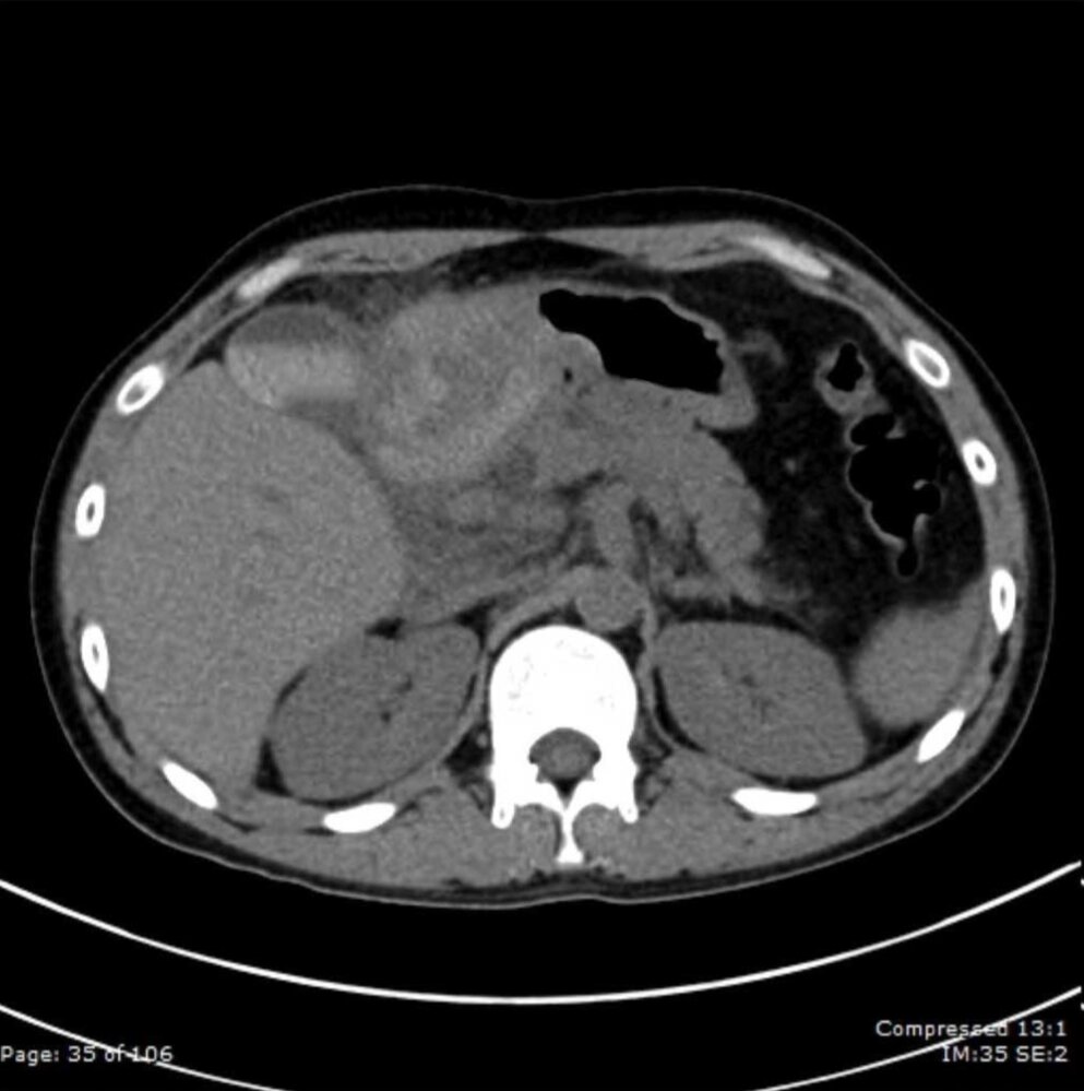 Mass in region of duodenum