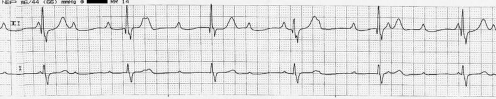 Third-degree atrioventricular block