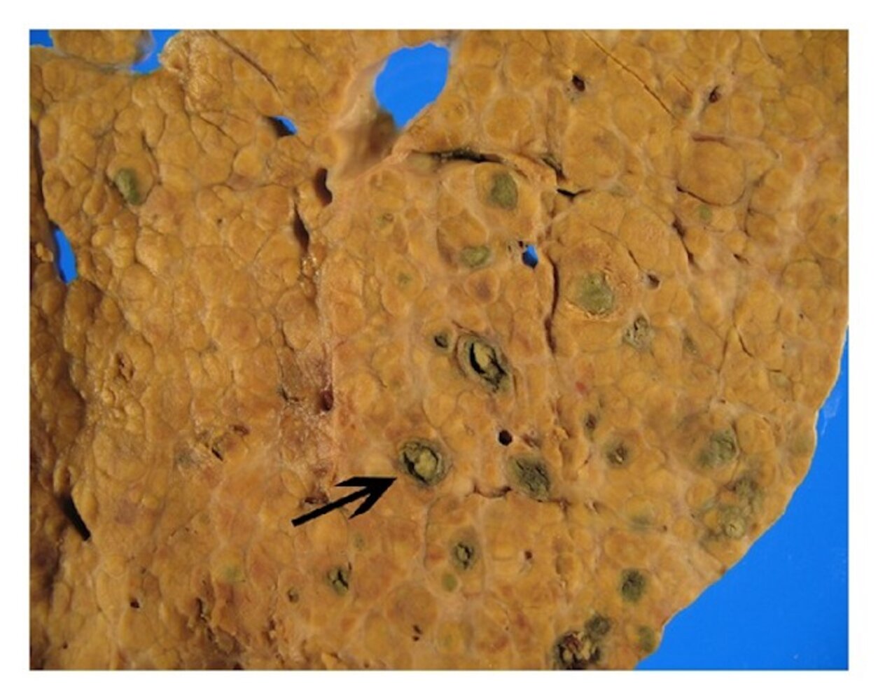 Cirrhotic liver with hepatocellular carcinoma