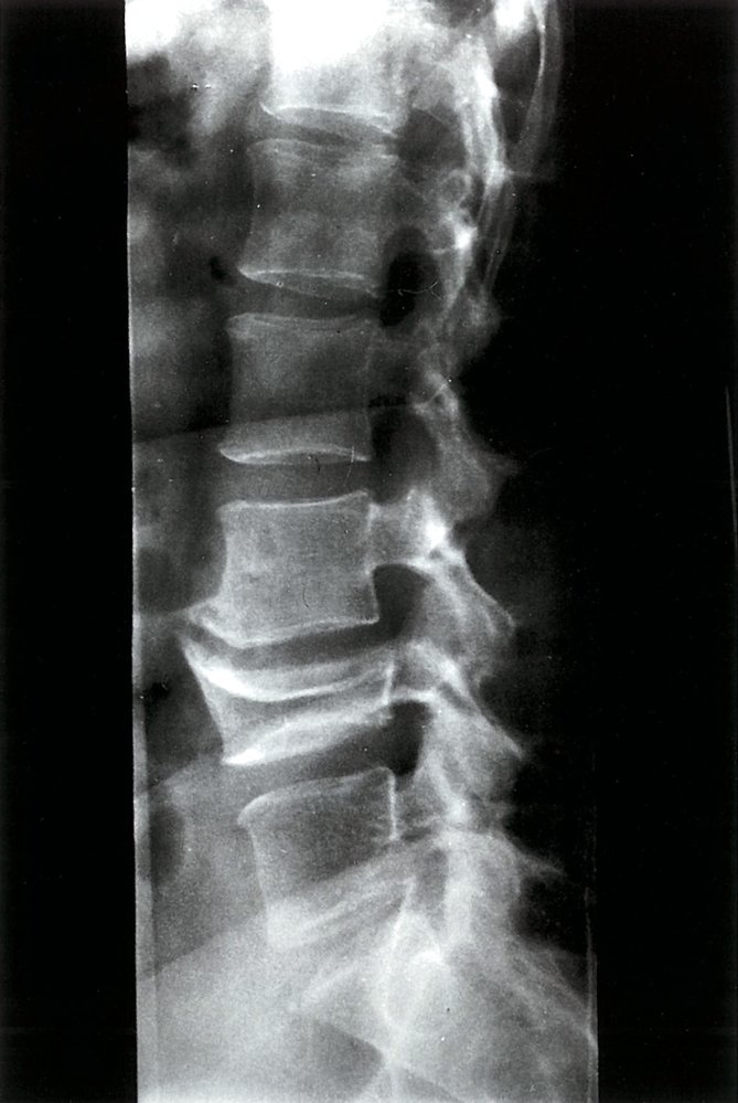 Chronic lumbar compression deformity