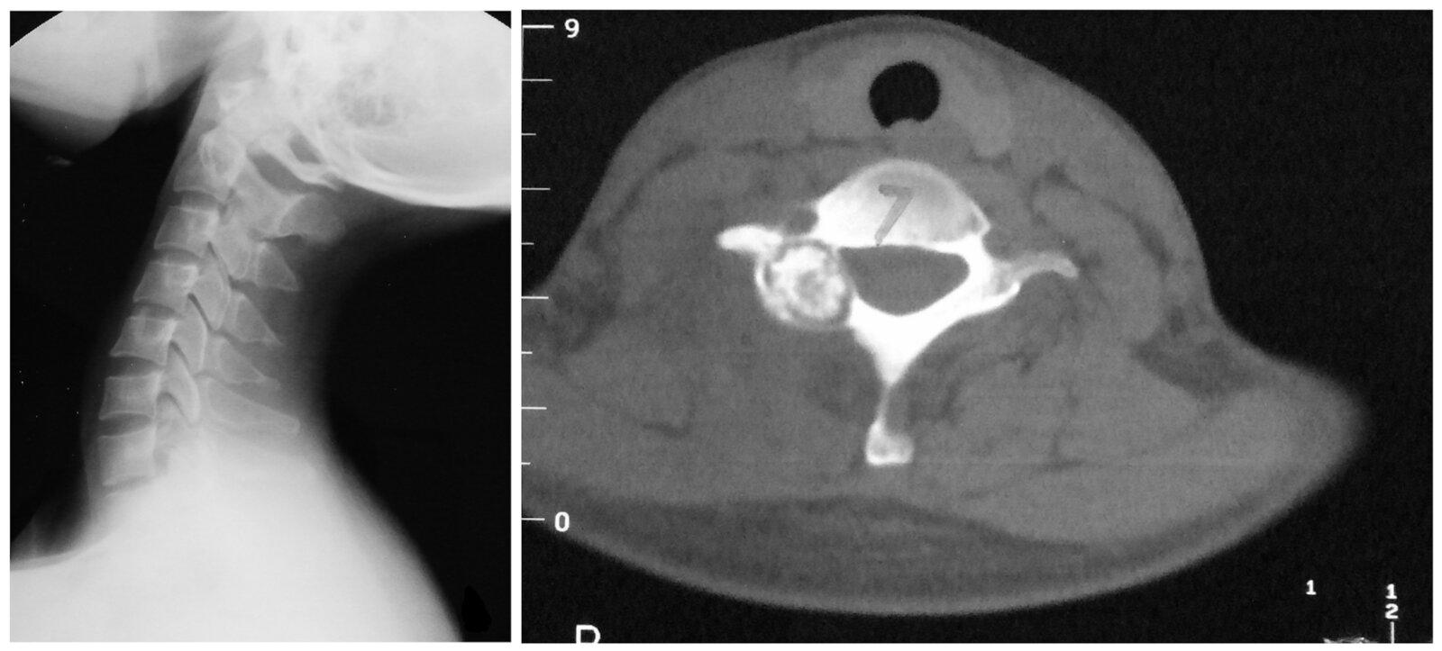 Osteoblastoma cervical spine