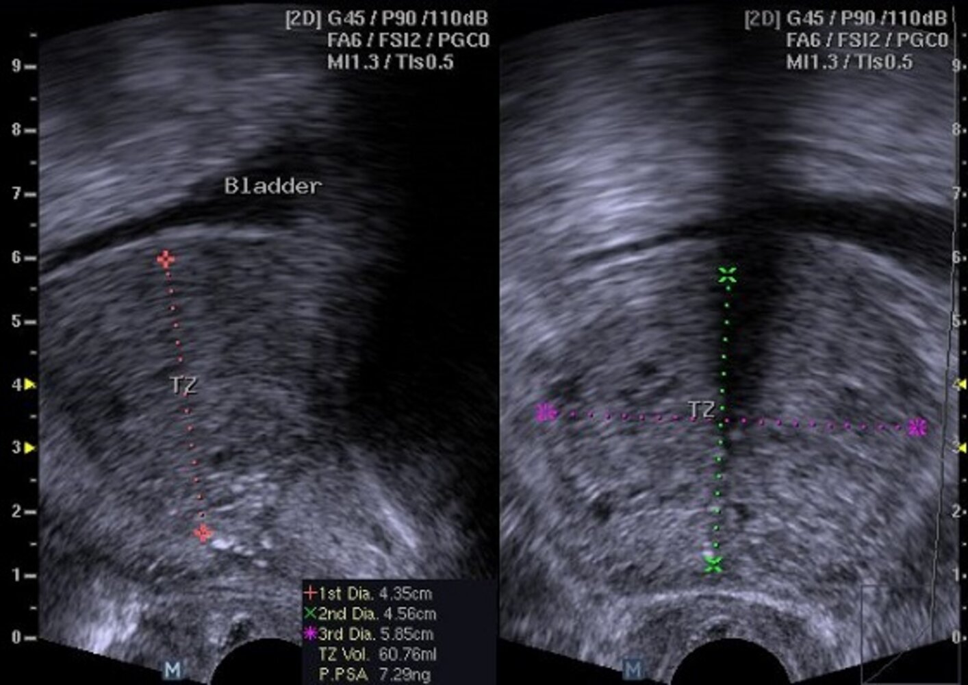 Benign prostatic hyperplasia
