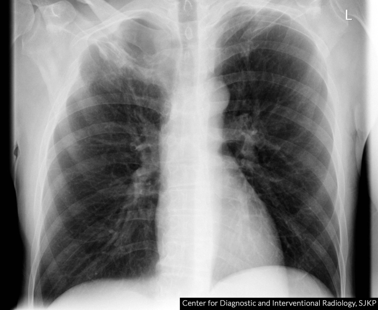 Pancoast tumor with chest wall extension