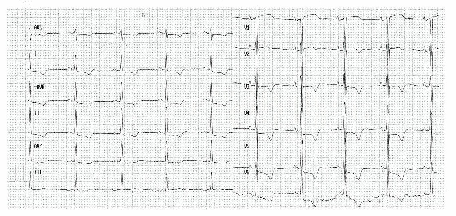 ECG in left ventricular hypertrophy