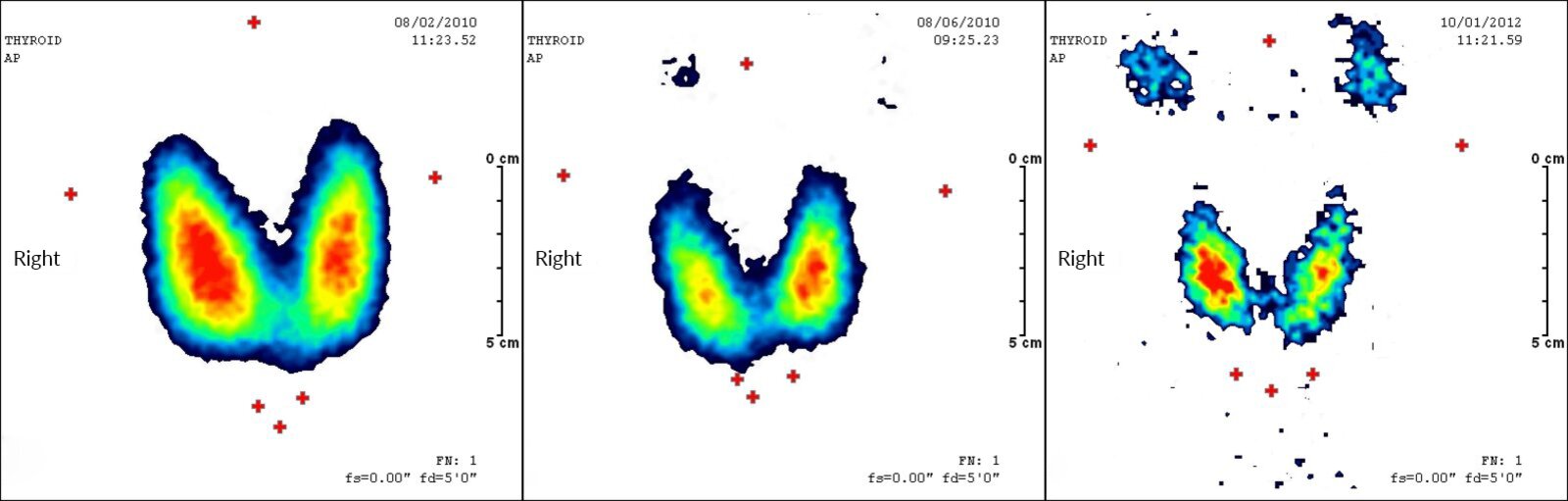 Thyroid scan before and after radioiodine therapy in Graves disease