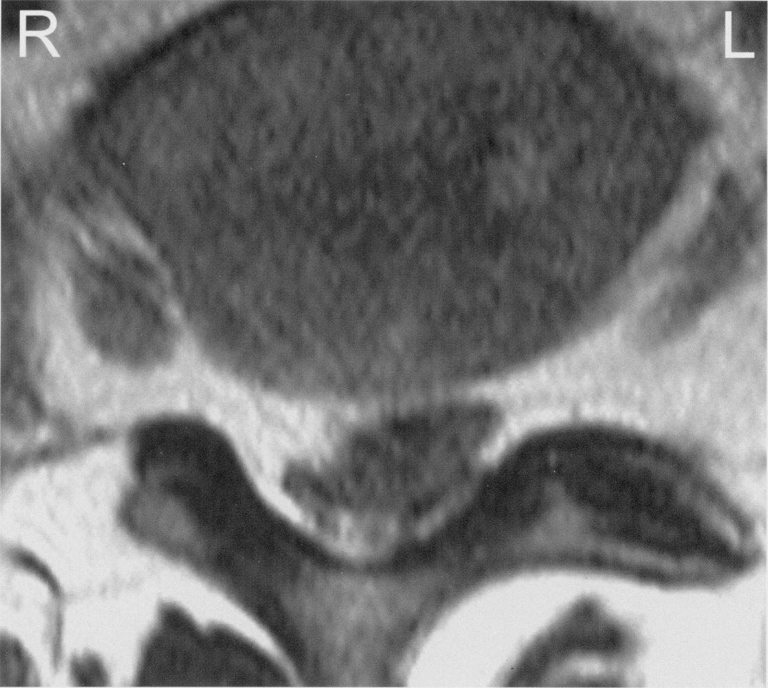 Spinal disk herniation with migration (2/3)