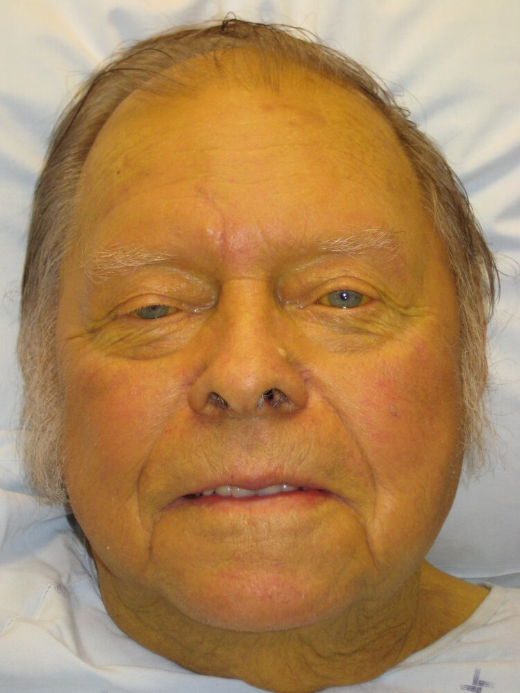 Jaundice (scleral and dermal icterus)
