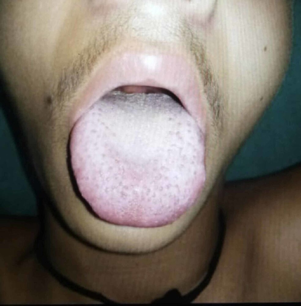 Strawberry tongue in Kawasaki disease
