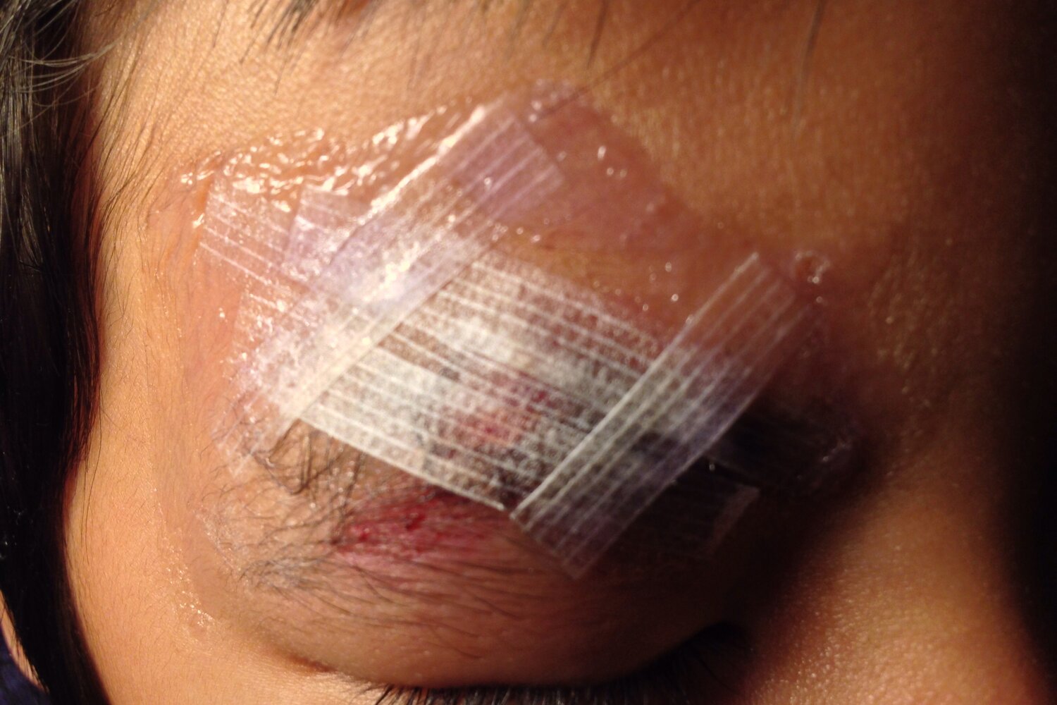 Wound closure strips