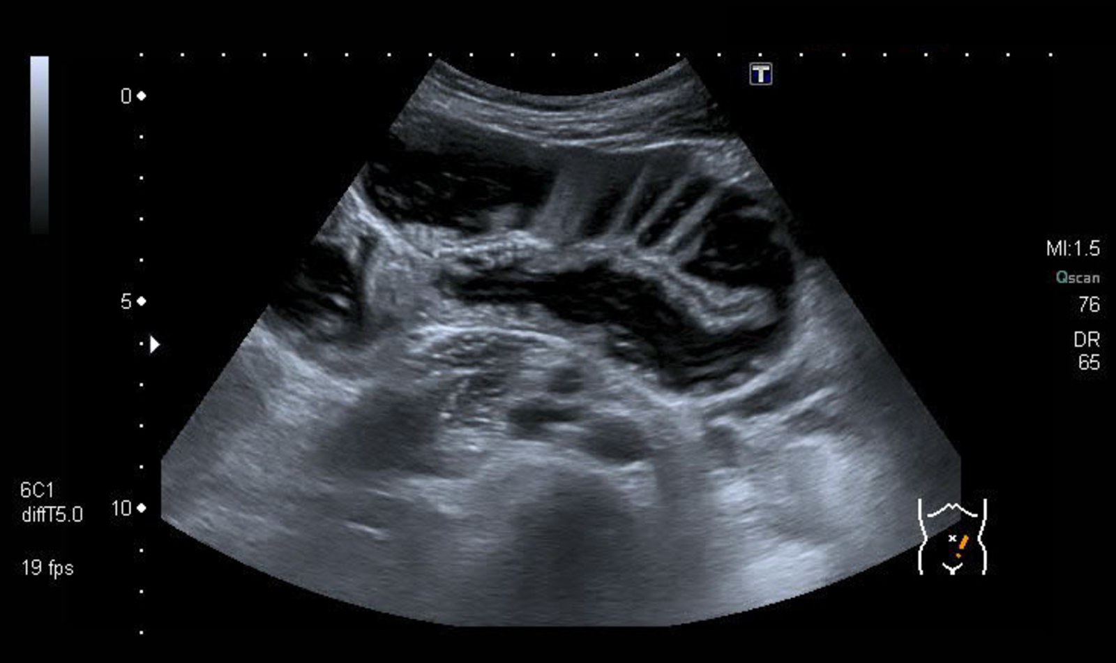 Dilated small bowel
