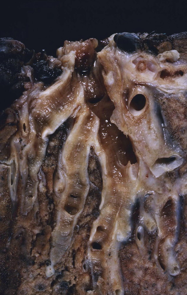 Bronchiectasis