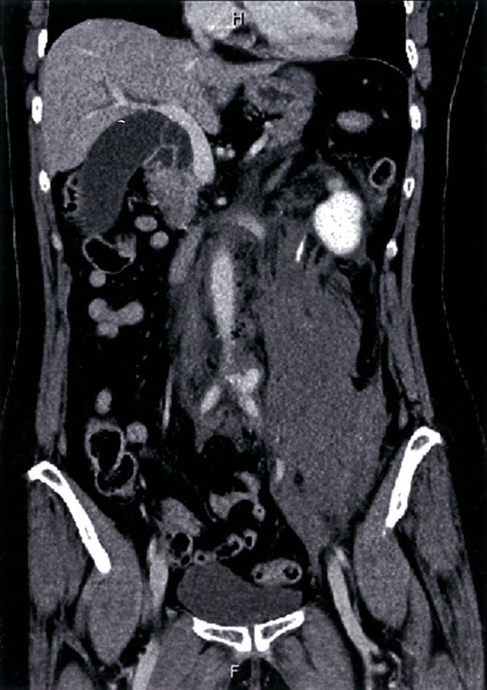 Retroperitoneal hemorrhage from the left common iliac artery