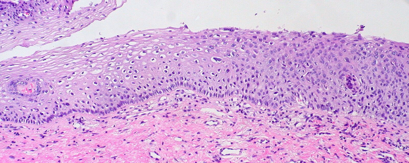 Spectrum of cervical dysplasia