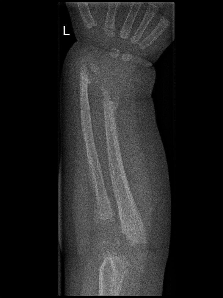 Rickets