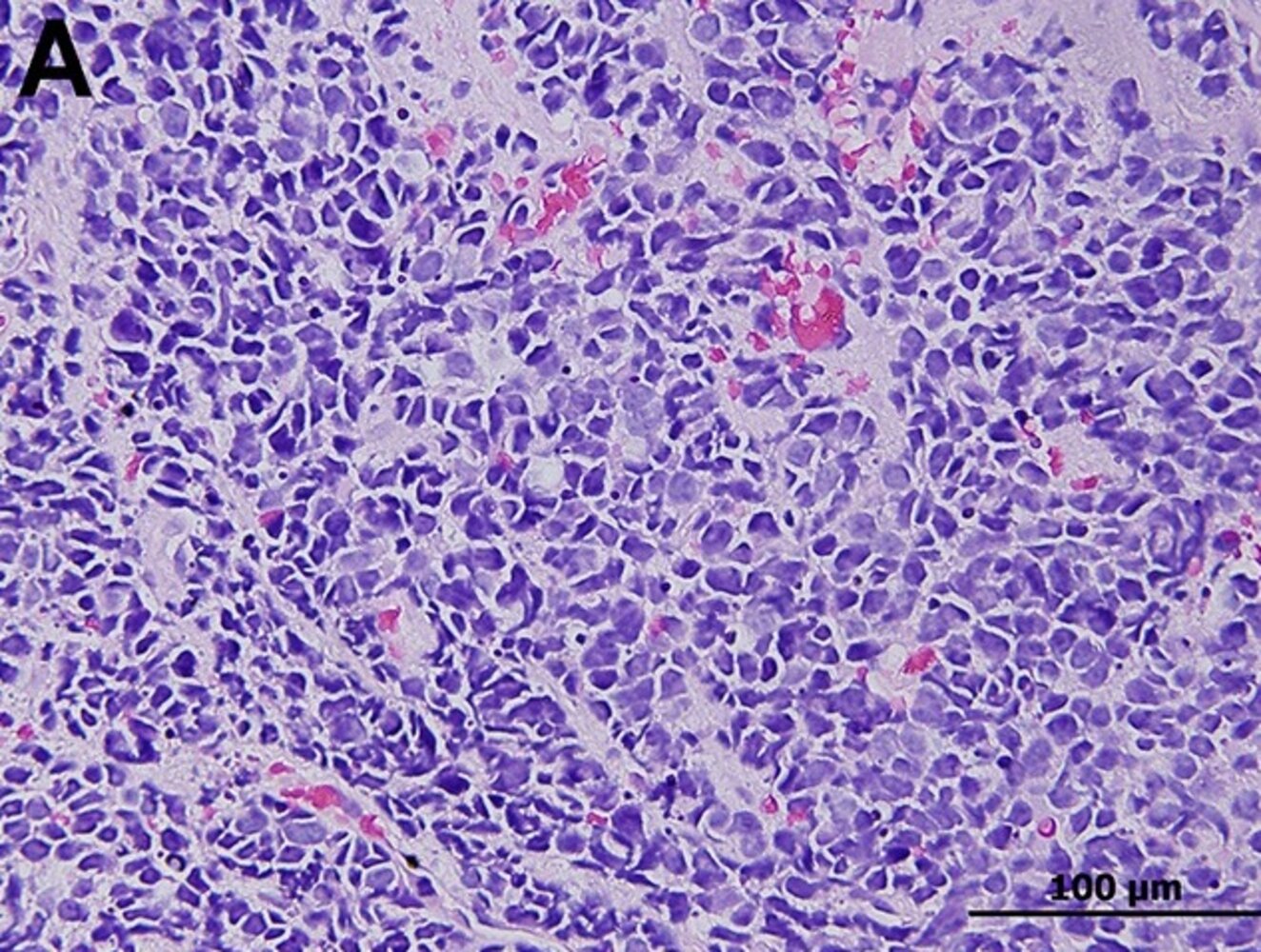Small cell lung cancer