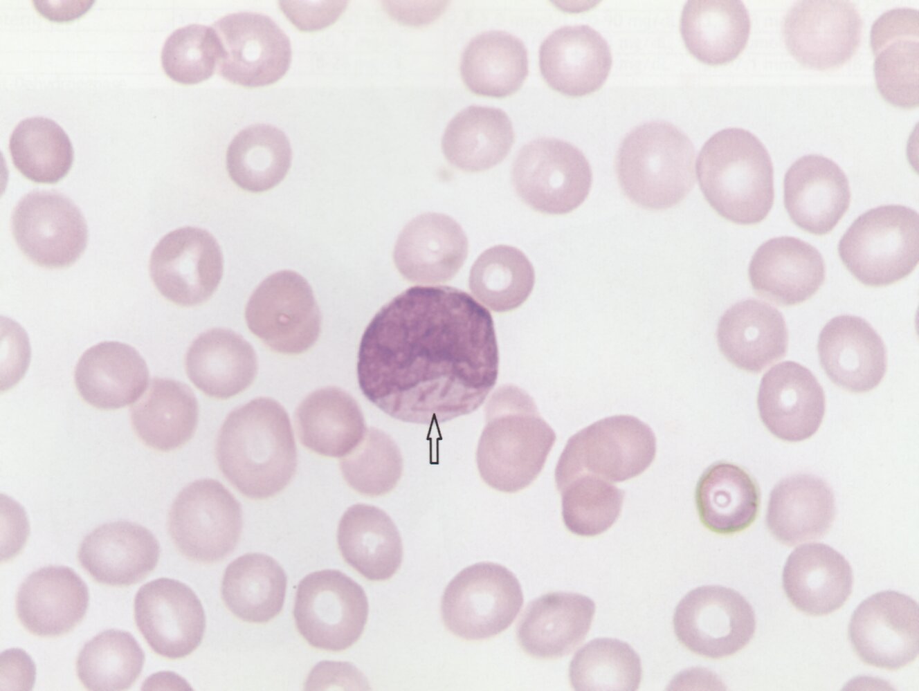 Auer rods in acute myeloblastic leukemia