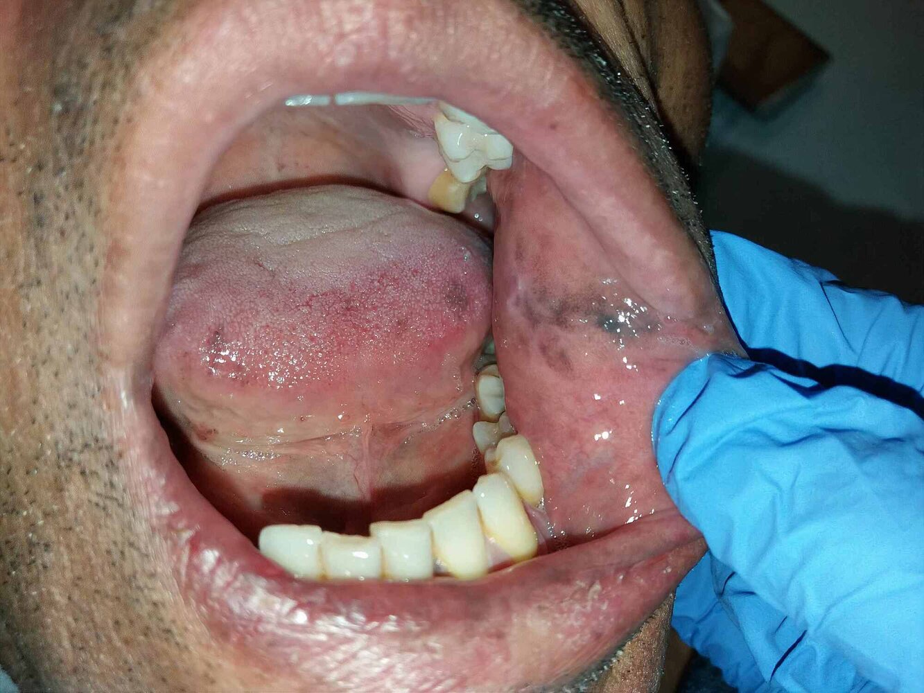 Addison hyperpigmentation
