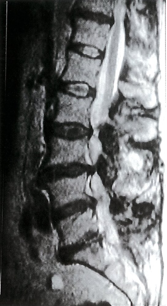 Lumbar spinal stenosis