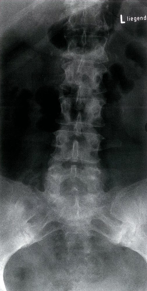 Sacroiliitis