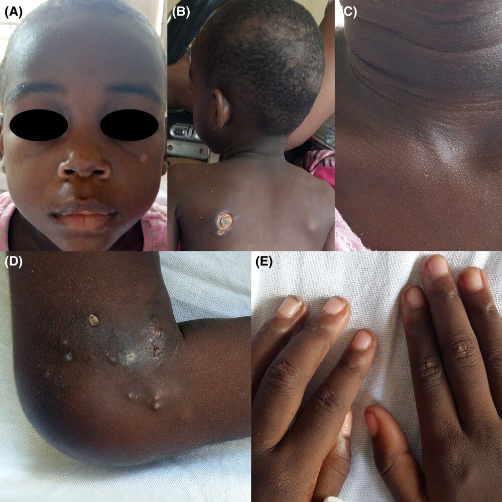 Cutaneous manifestations of dermatomyositis
