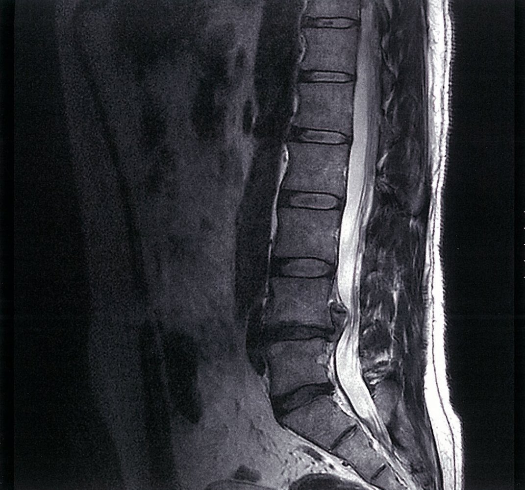 Degenerative disk disease with disk extrusion