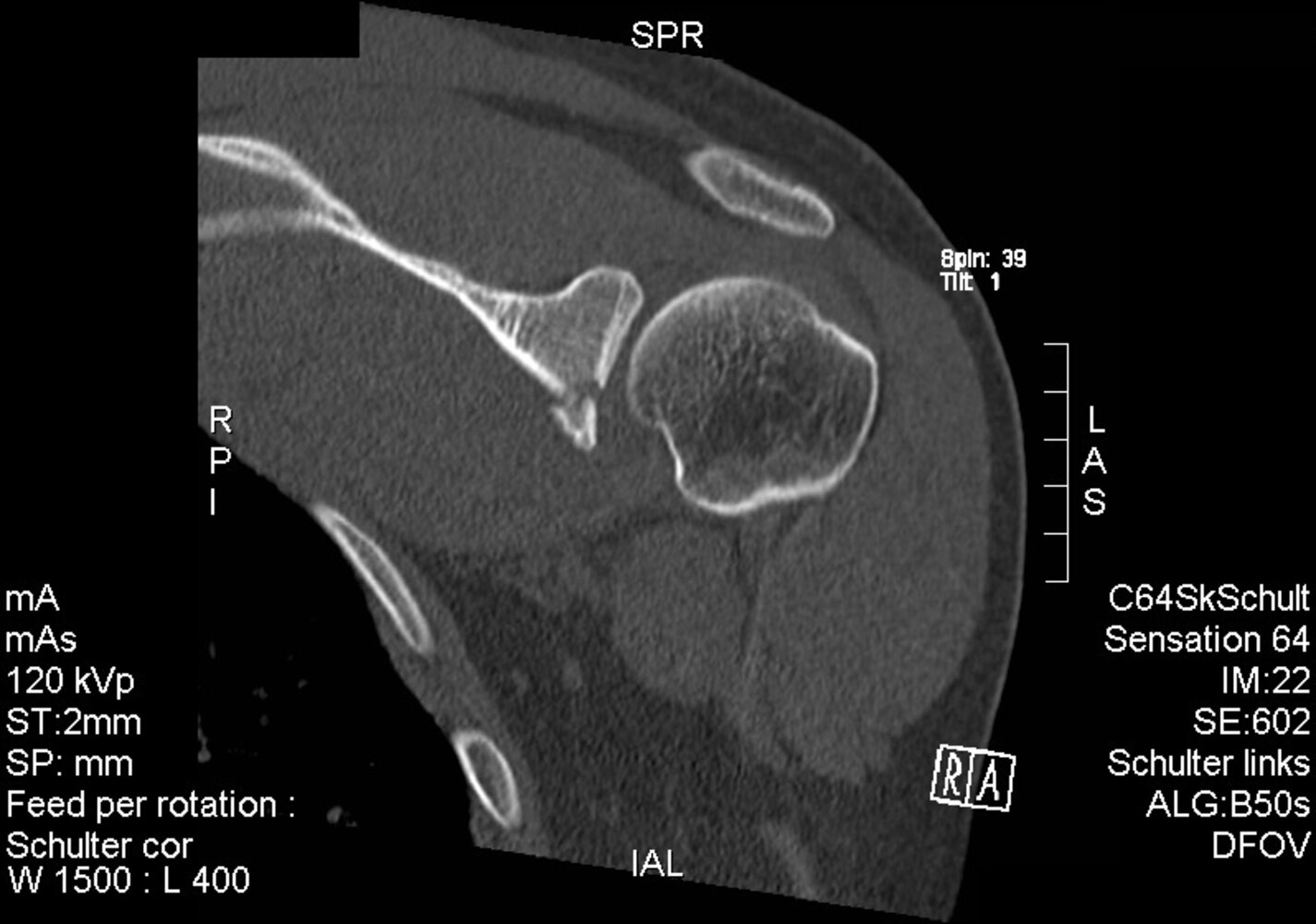 Bankart lesion