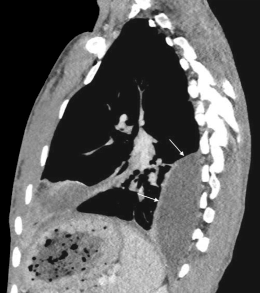 Loculated pleural collection (2/2)