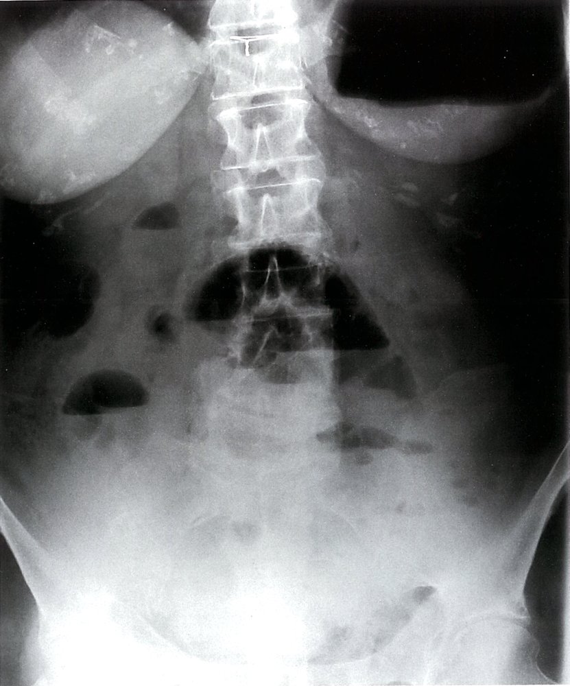 Mechanical small bowel obstruction