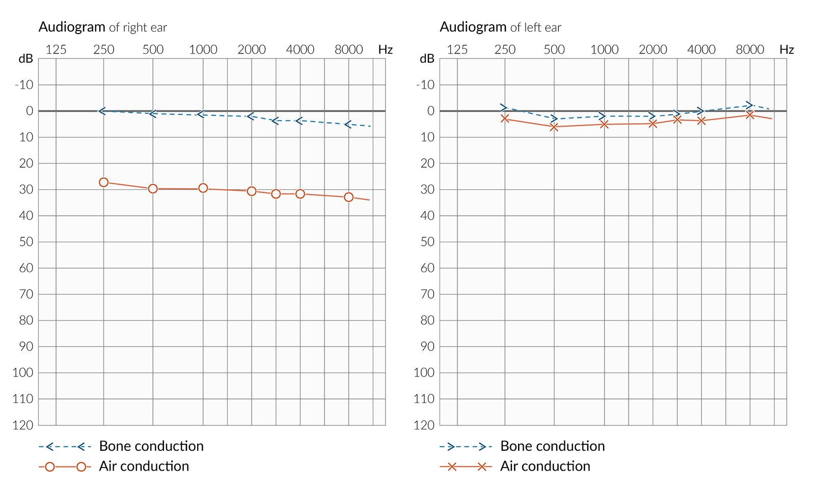 Conductive hearing loss