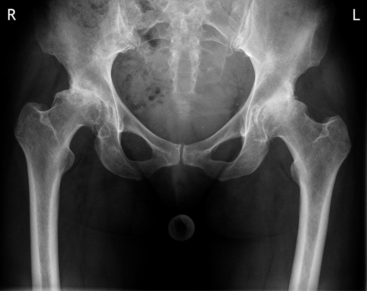 Bilateral hip osteoarthritis