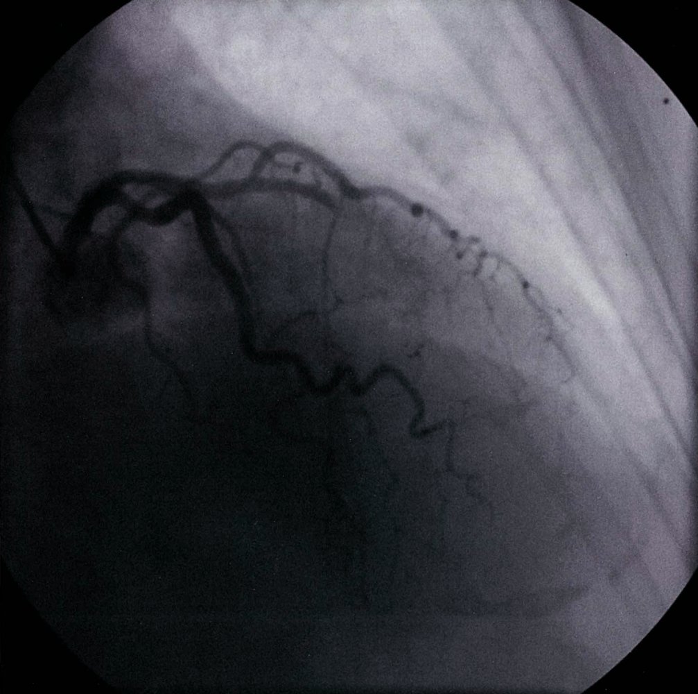 Coronary angiography in acute anterior myocardial infarction