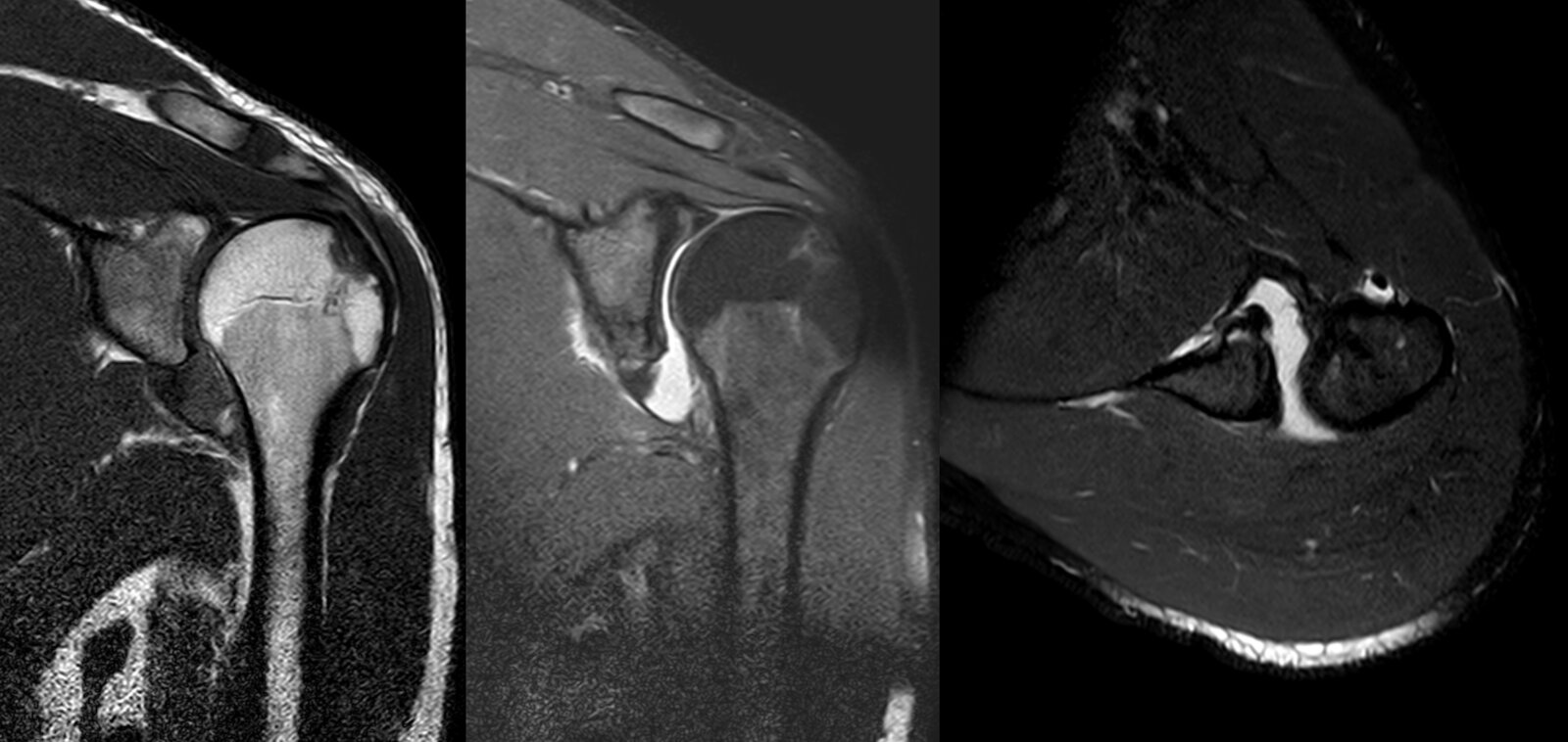 Bankart and Hill-Sachs lesions