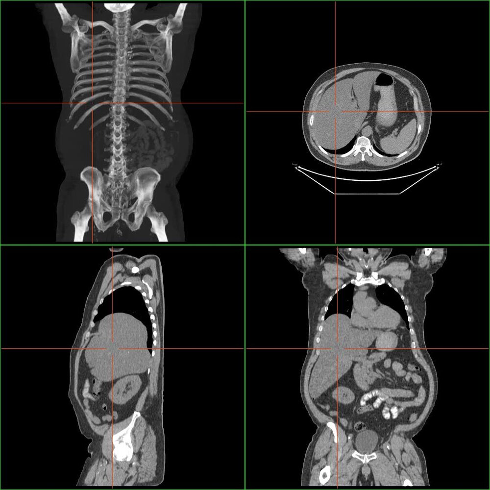 Hepatomegaly