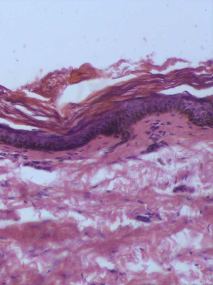 Congenital melanocytic nevus