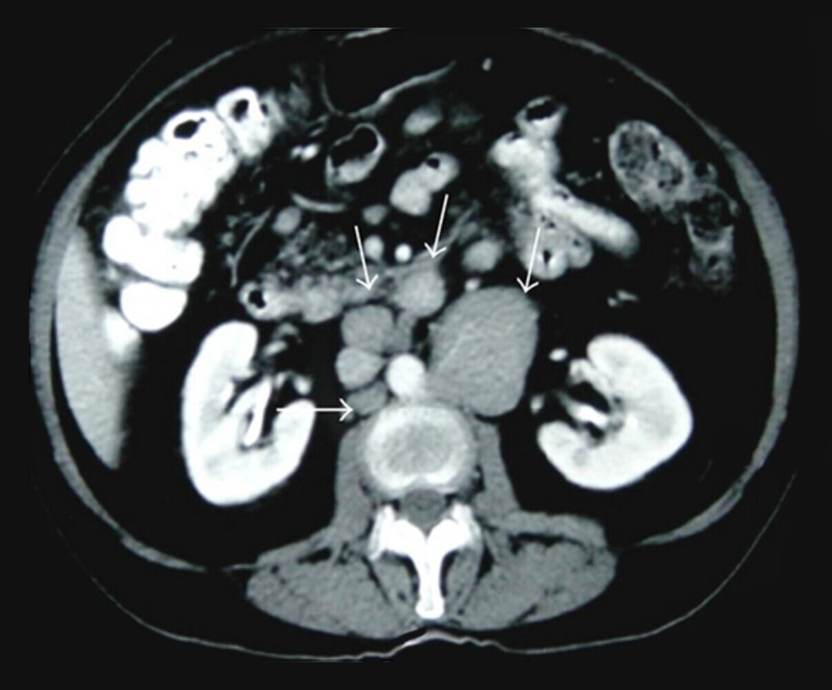 Enlarged retroperitoneal lymph nodes