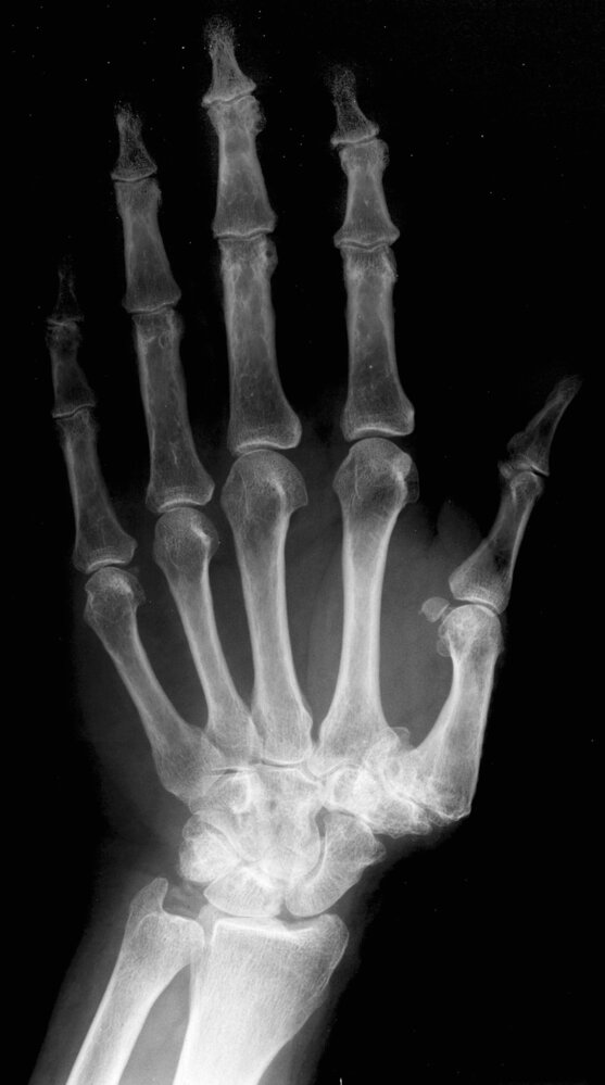 Trapeziometacarpal osteoarthritis