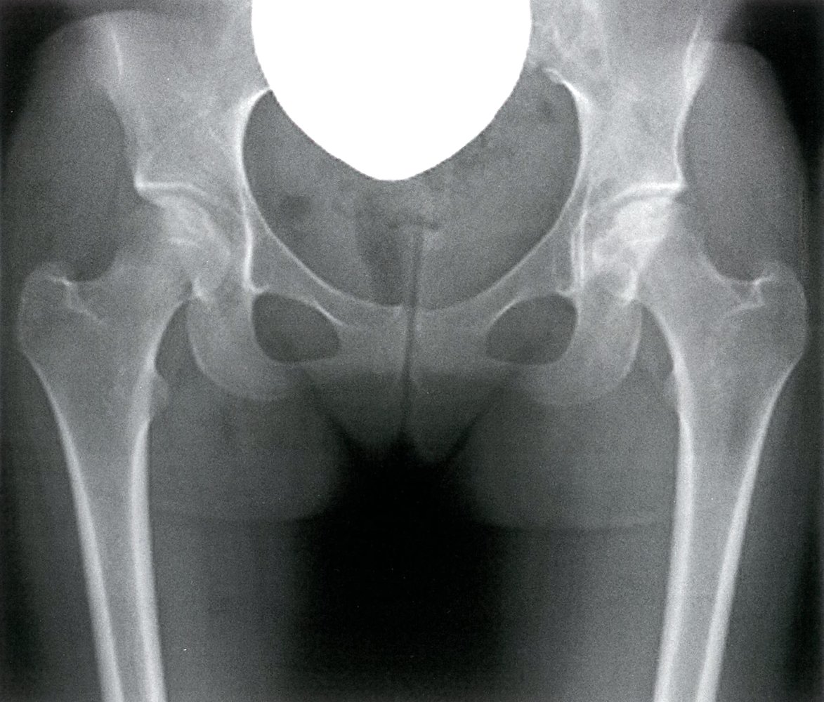 Bilateral femoral head avascular necrosis