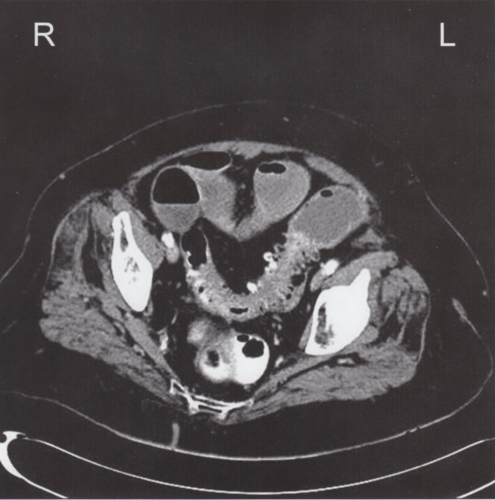 Intestinal obstruction from chronic diverticulitis (2/3)