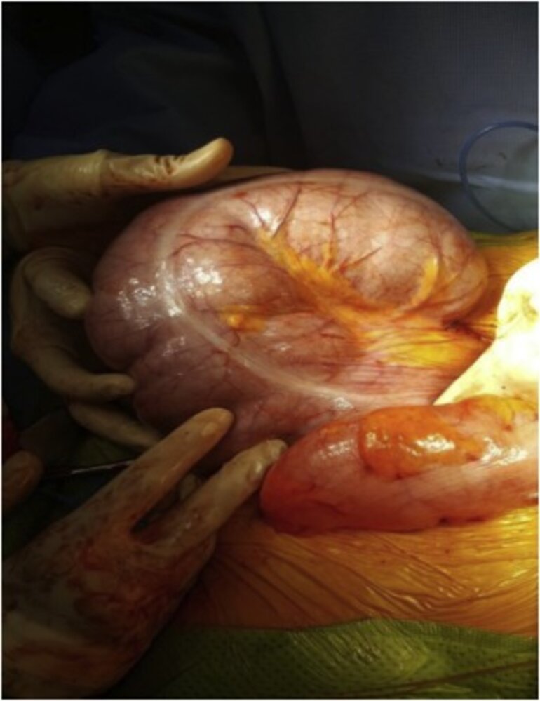 Cecal volvulus