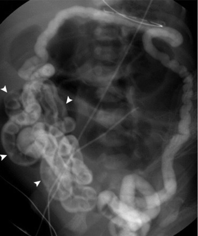 Meconium ileus