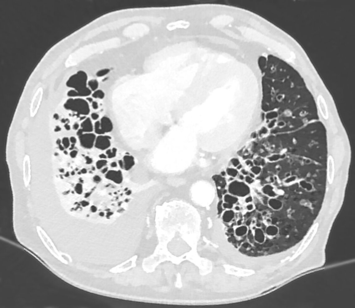 Bronchiectasis