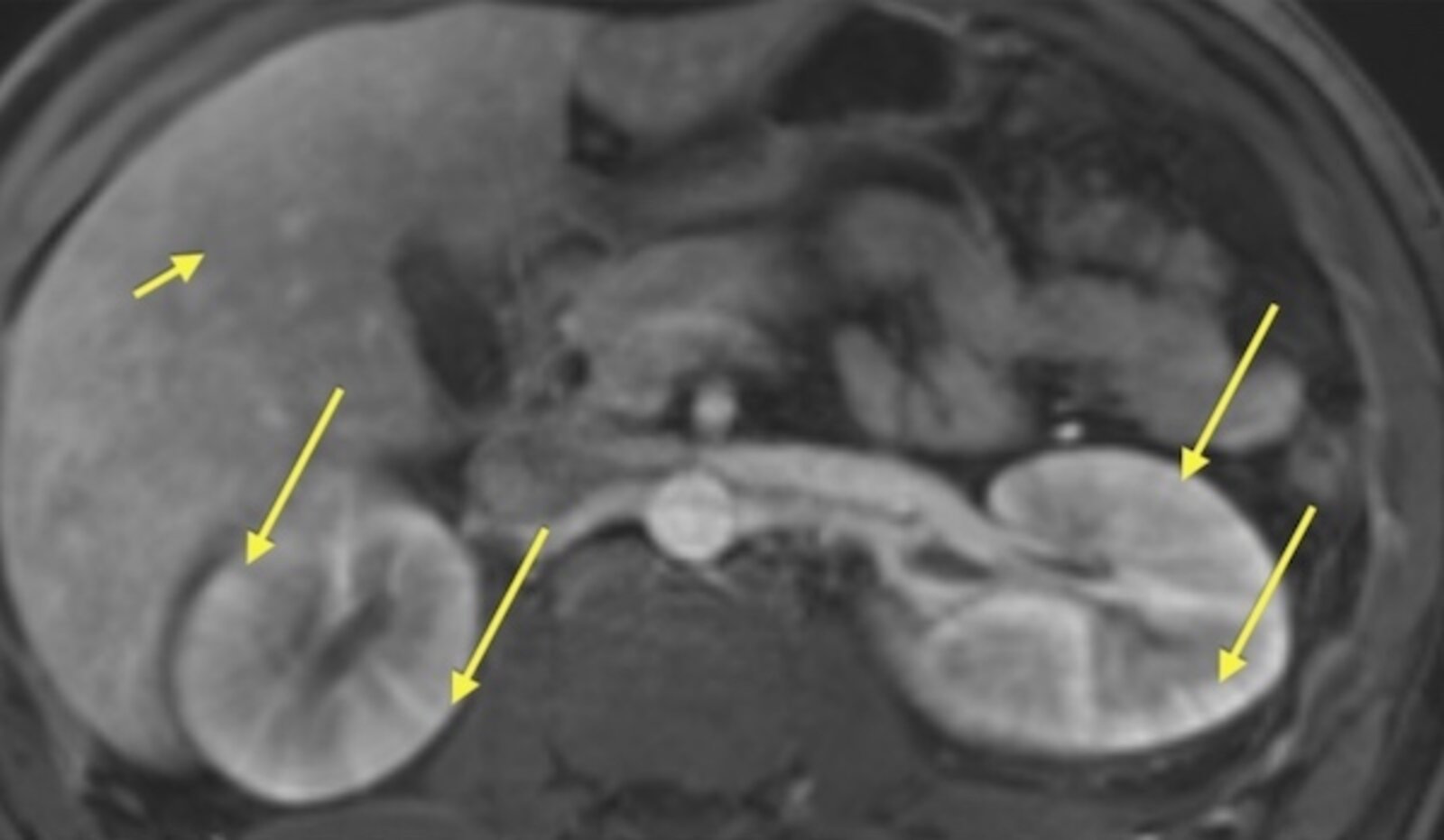 Striated nephrogram