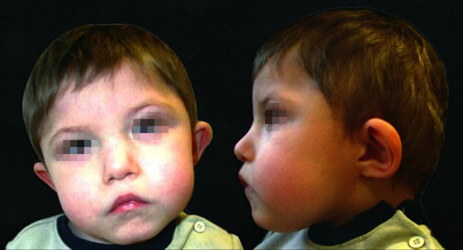 Facial features in DiGeorge syndrome