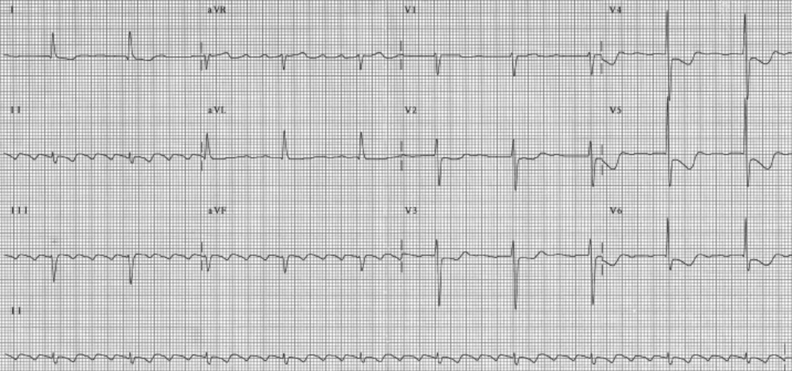 Atrial flutter with 4:1 conduction