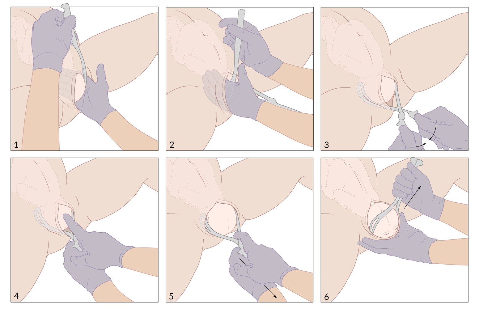 Forceps delivery