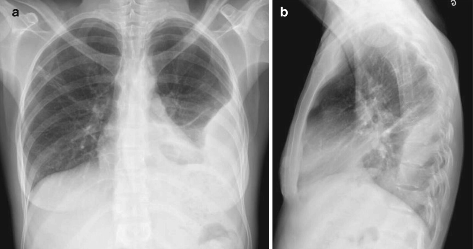 Loculated pleural collection (1/2)