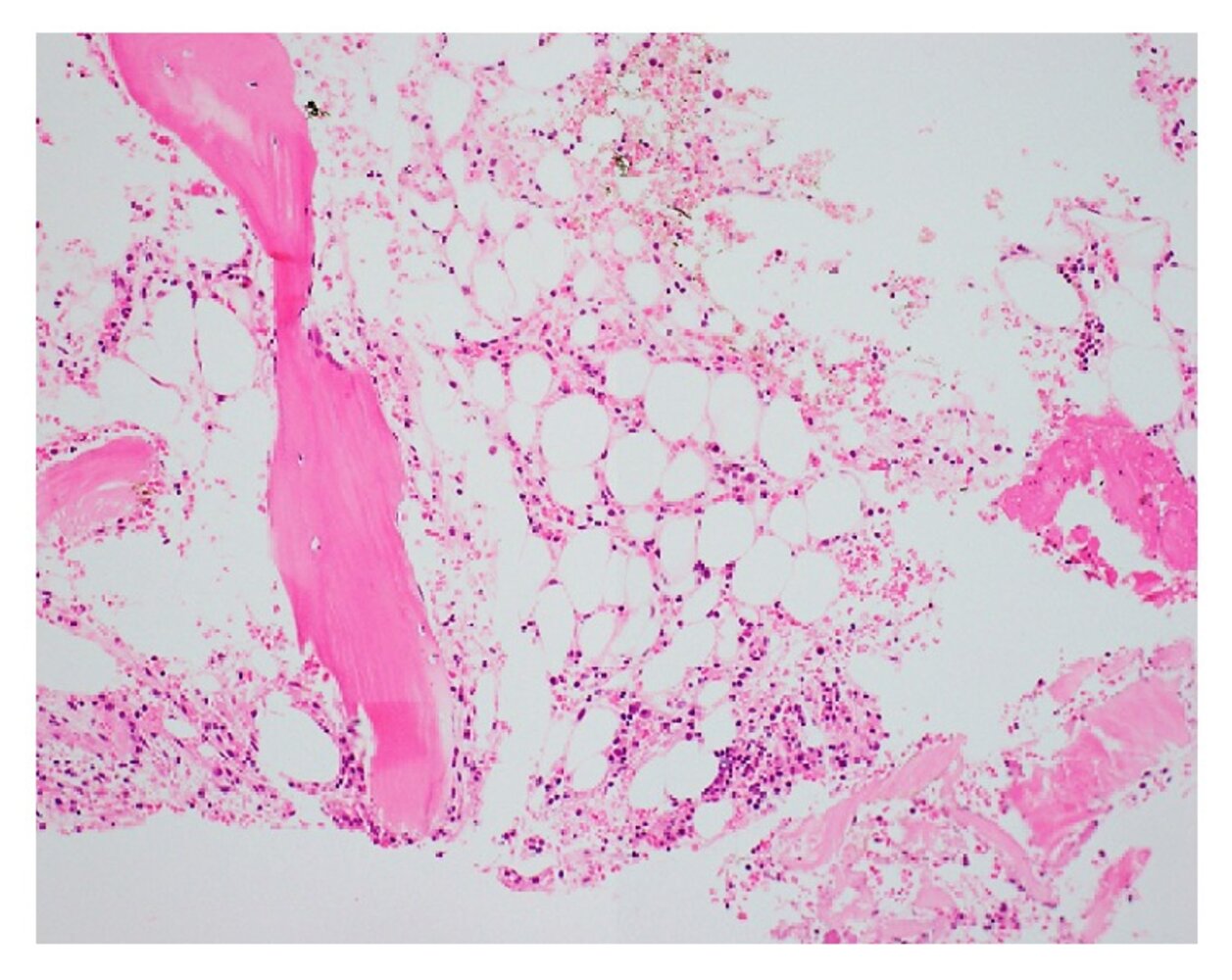 Aplastic anemia