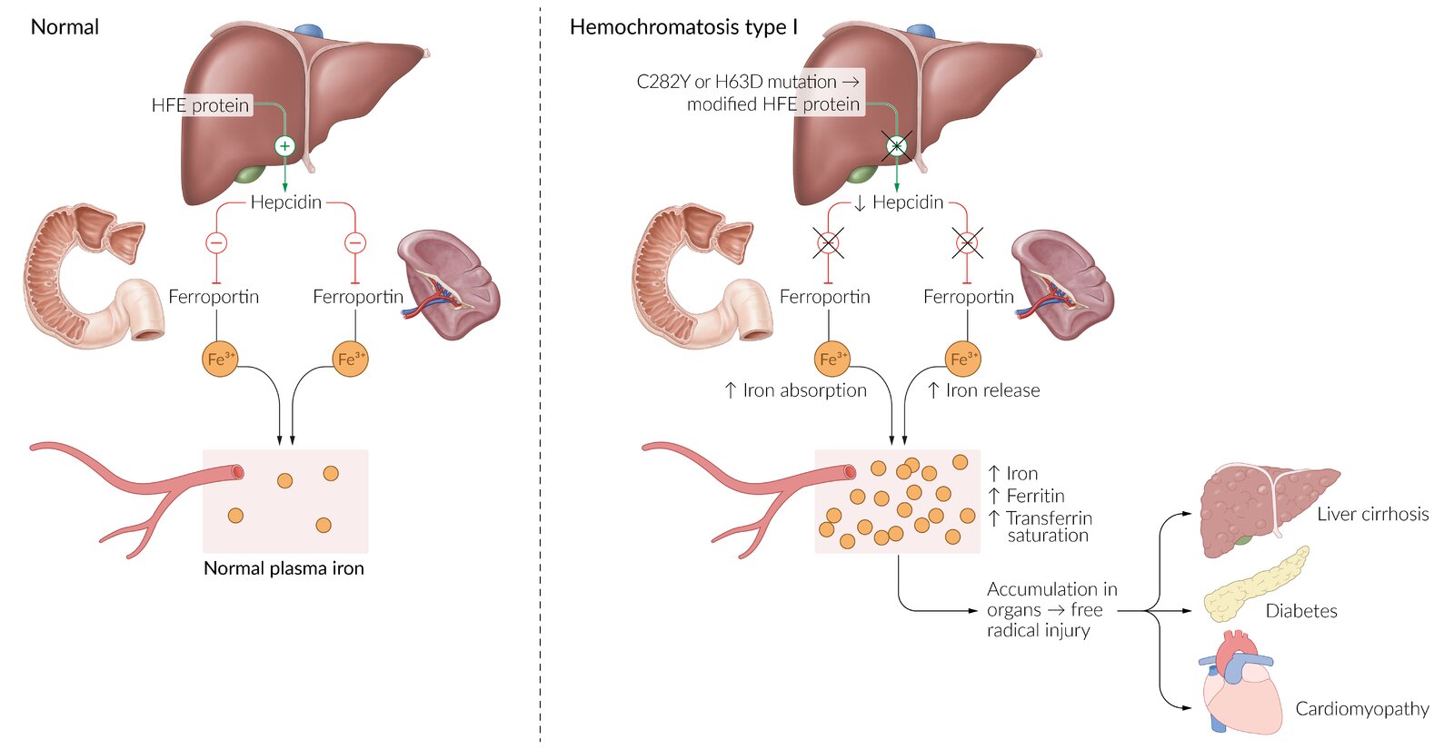 Pathophysiology of hemochromatosis