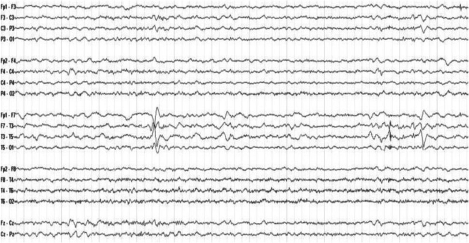 Anterior temporal spikes and sharp waves