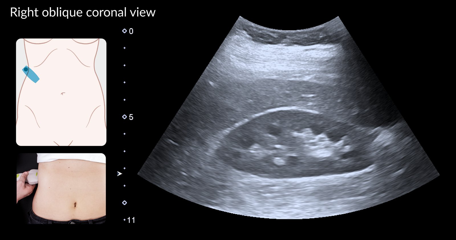 Normal ultrasound right kidney